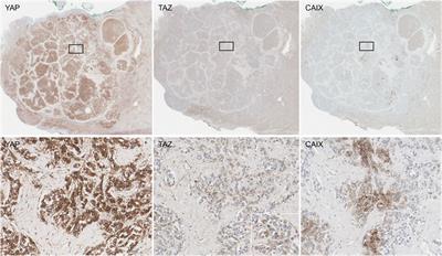 The Clinicopathological Significance of YAP/TAZ Expression in Hepatocellular Carcinoma with Relation to Hypoxia and Stemness